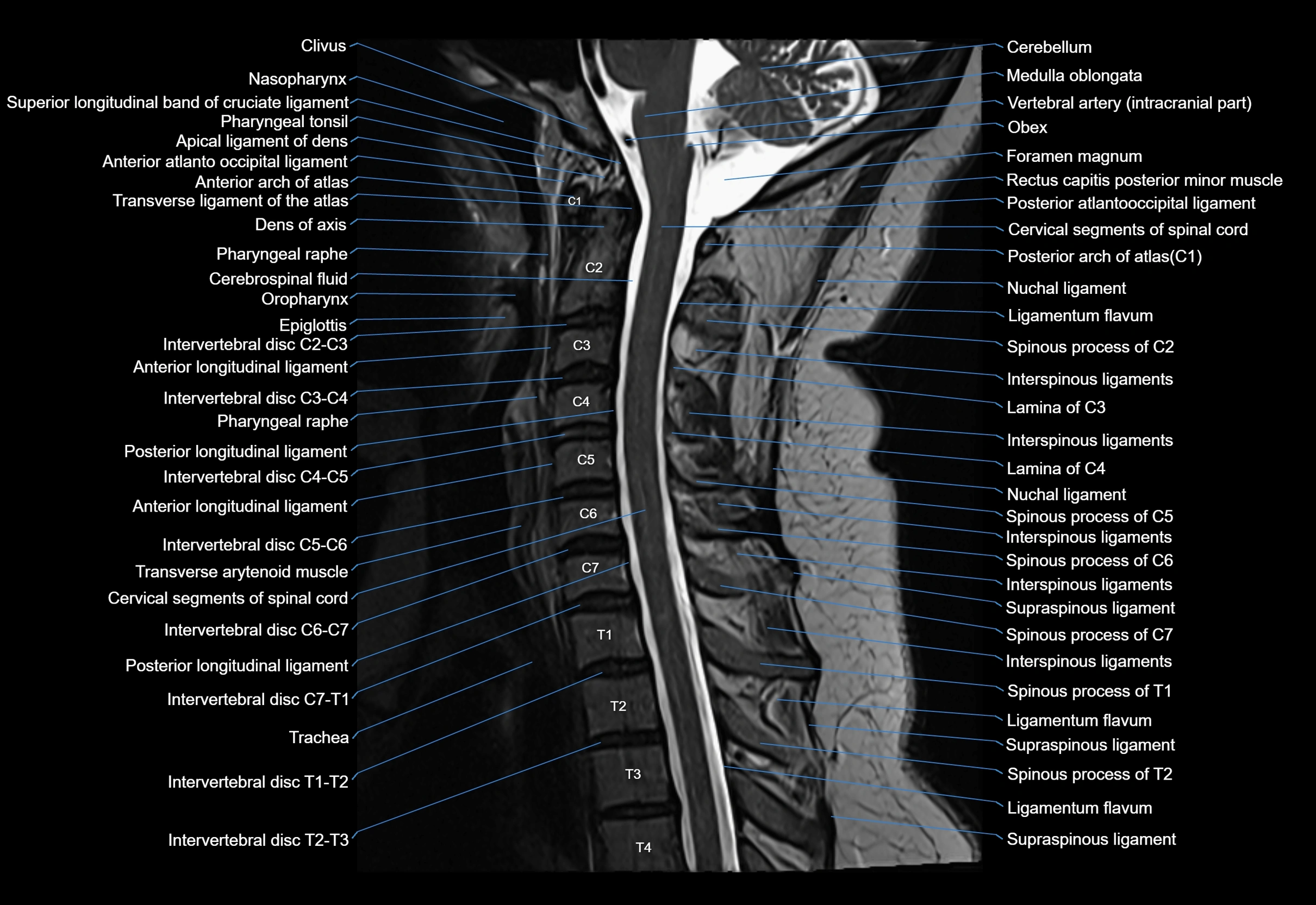 cervical spine cross sectional MRI anatomy 3T MRI  sagittal image-img-00001-00017.webp